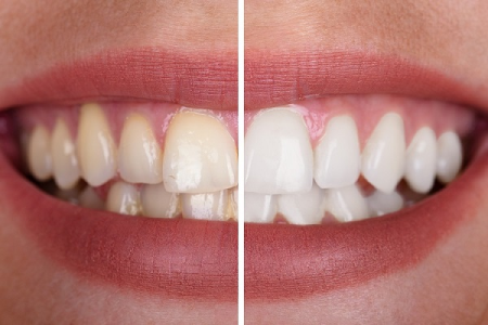 Transform your Smile Fresh Smile Dental